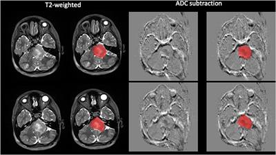 Evaluating drug distribution in children and young adults with diffuse midline glioma of the pons (DIPG) treated with convection-enhanced drug delivery